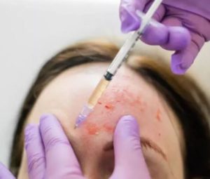 Two People Infected With HIV ‘After Beauty Salon Used Dirty Needles For Vampire Facials’ 1